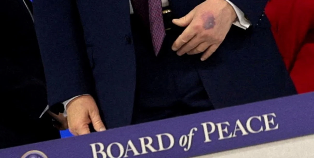 Ante nuevos rumores, Trump explicó por qué tiene moretones en las manos