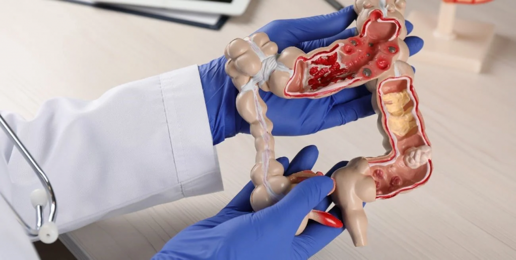 Cáncer colorrectal: un nuevo tratamiento mejora la sobrevida en pacientes
