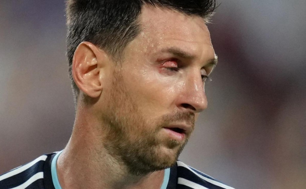 Qu&eacute; le pas&oacute; a Messi en el ojo durante el triunfo de Argentina ante Suiza