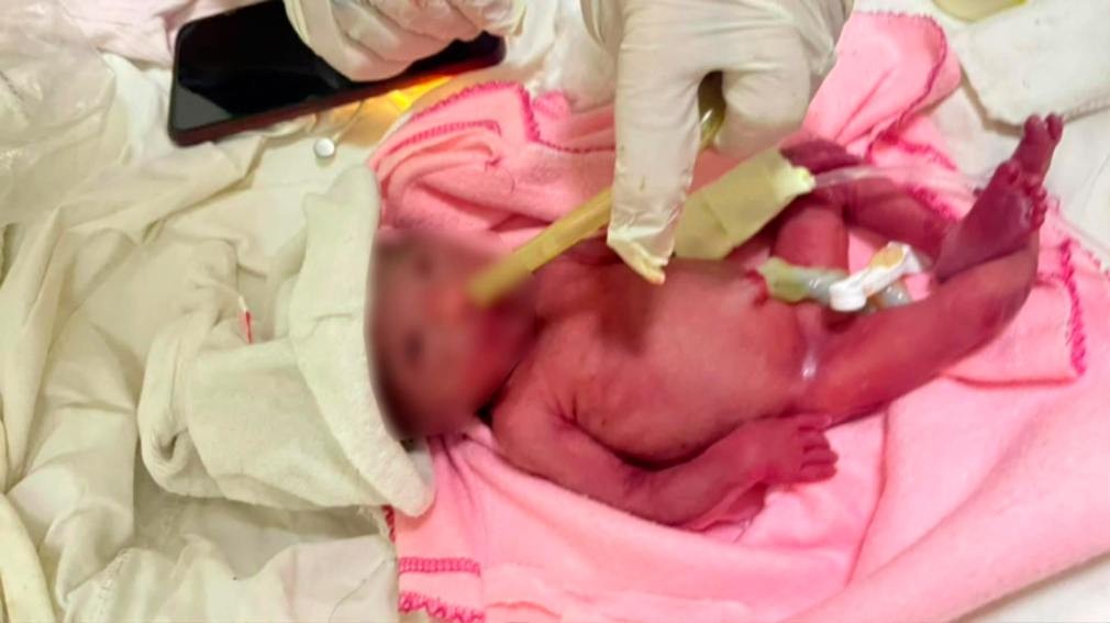 Con 24 semanas de gestaci&oacute;n y apenas 500 gramos, naci&oacute; una beb&eacute; en Quimil&iacute;