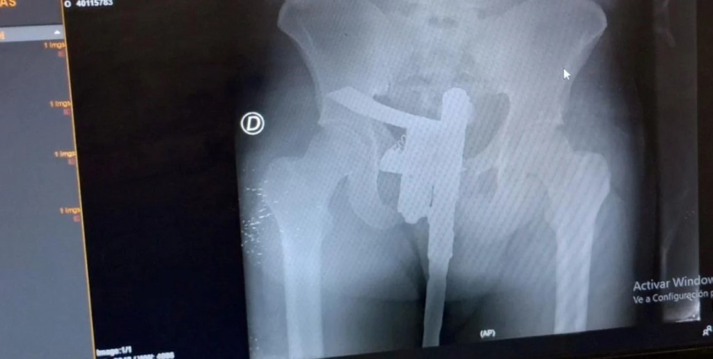 Radiografía con sorpresa: buscaban una fractura y encontraron un arma de fuego