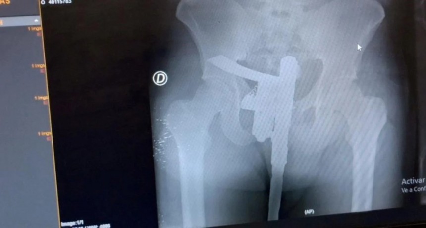 Radiografía con sorpresa: buscaban una fractura y encontraron un arma de fuego