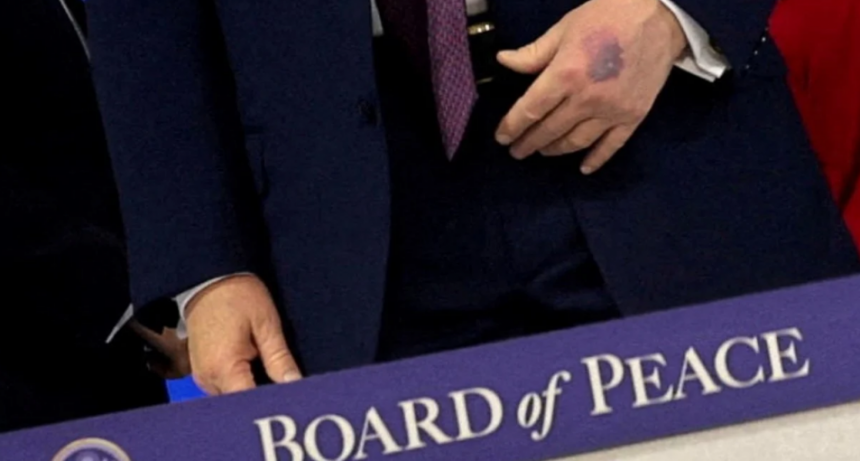 Ante nuevos rumores, Trump explicó por qué tiene moretones en las manos