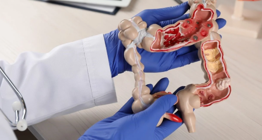 Cáncer colorrectal: un nuevo tratamiento mejora la sobrevida en pacientes