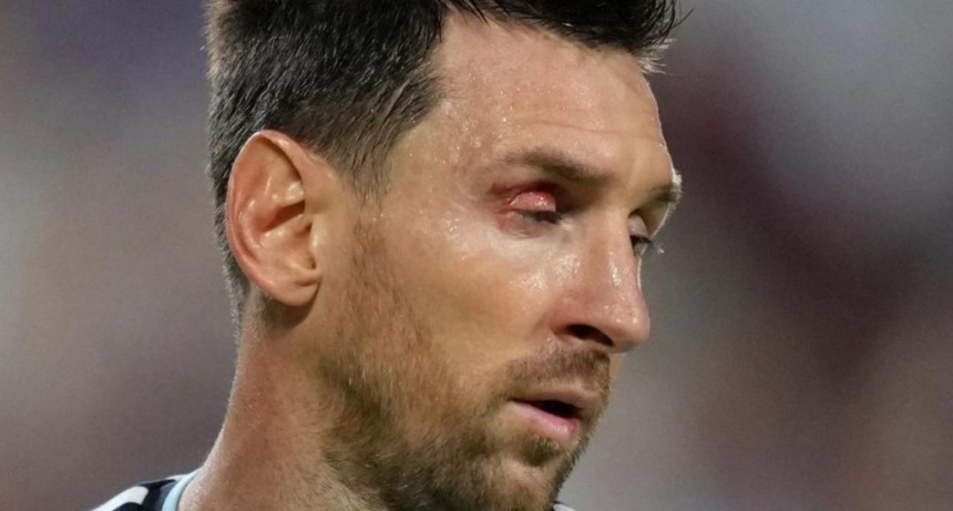 Qu&eacute; le pas&oacute; a Messi en el ojo durante el triunfo de Argentina ante Suiza