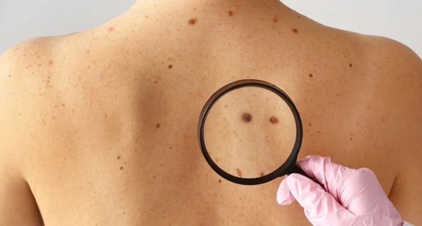Dermatólogos chequearán lunares de manera gratuita para concientizar sobre el cáncer de piel